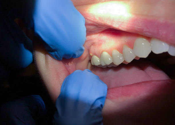 Best Emergency Gum Treatment in Hardinsburg, KY